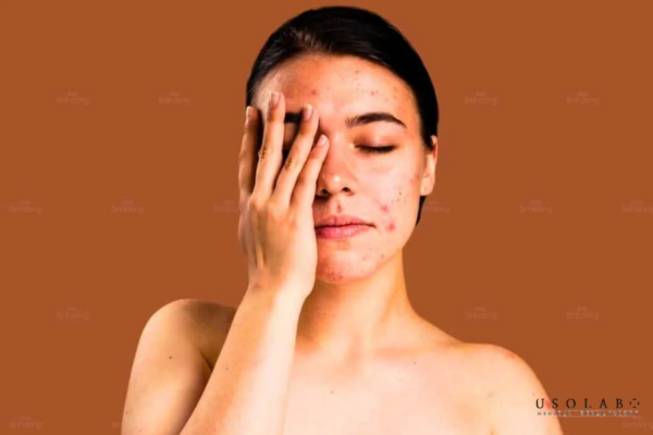 phục hồi da nóng rát sau treatment