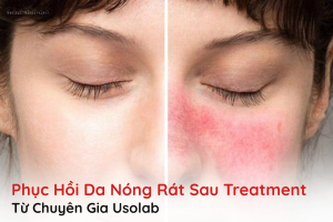 phục hồi da nóng rát sau treatment
