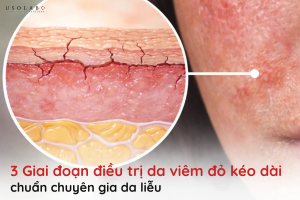 da viêm đỏ kéo dài