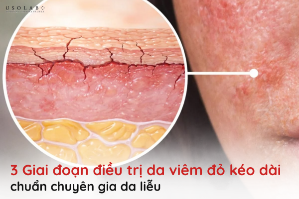 da viêm đỏ kéo dài