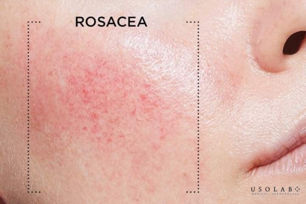Da yếu có nên dùng Ceramide không