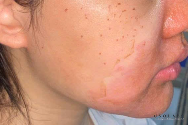 dưỡng da sau peel