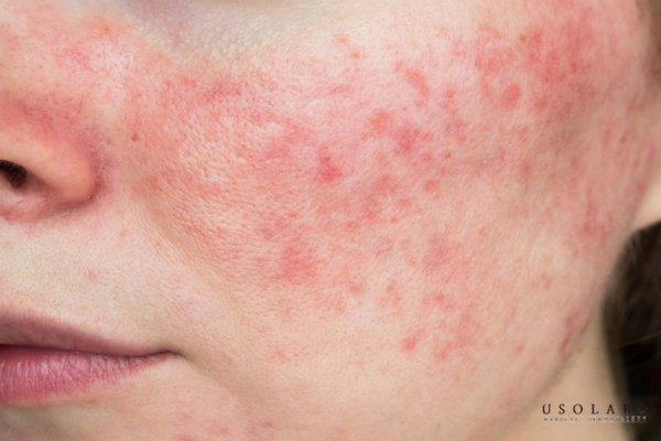 ectoin giảm kích ứng