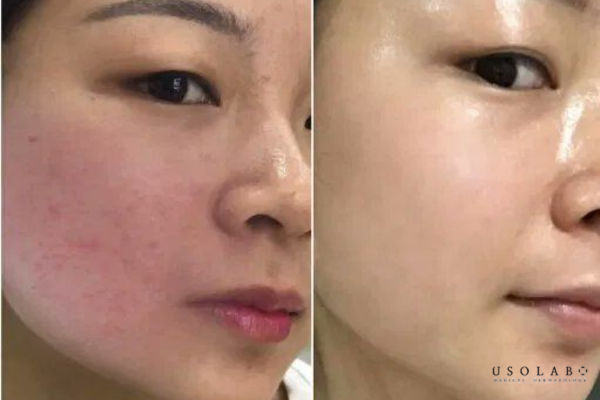 ectoin giảm kích ứng