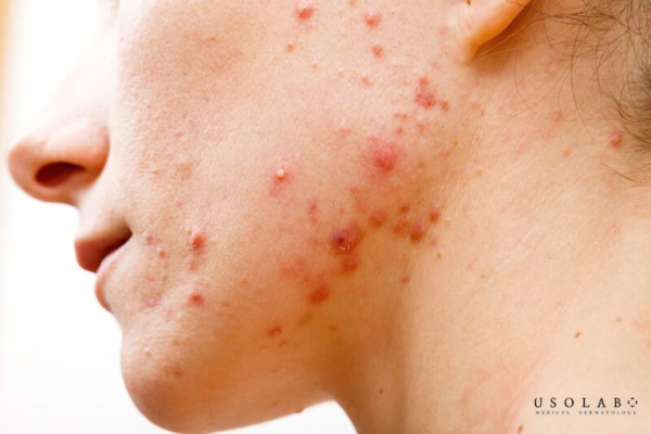 ectoin phục hồi da