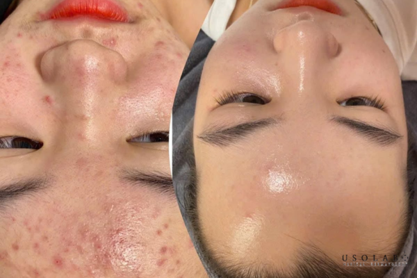 giảm bầm sau laser
