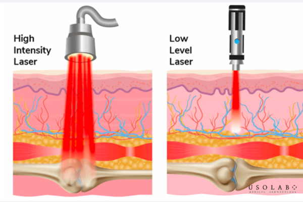 giảm bầm sau laser