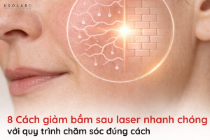 giảm bầm sau laser