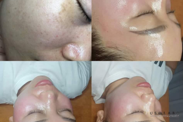 giảm bầm sau laser