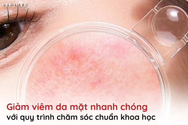 giảm viêm da mặt