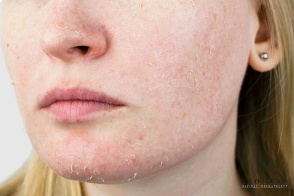 kem phục hồi da sau treatment
