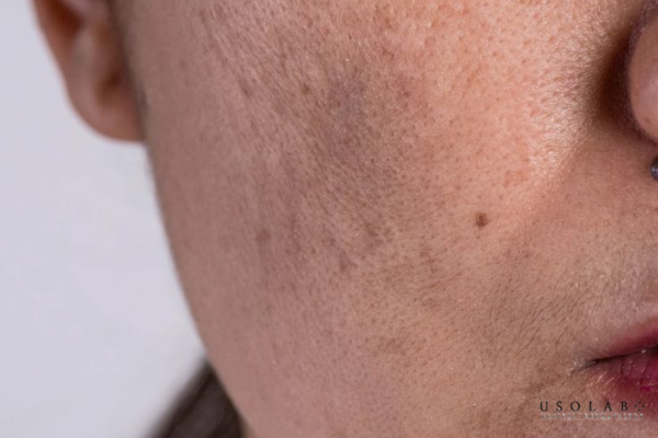 kem phục hồi da sau treatment