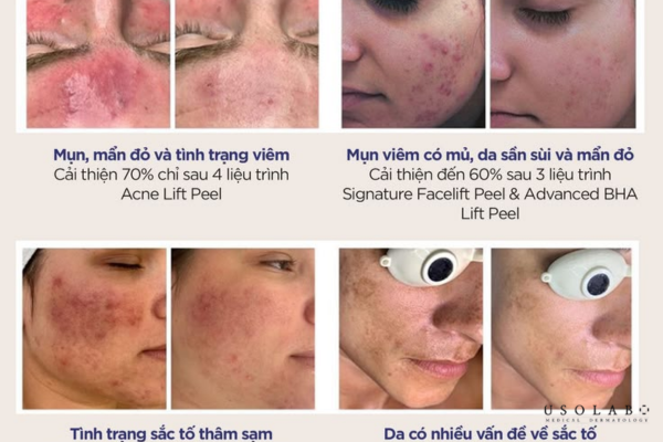 kem phục hồi da sau treatment