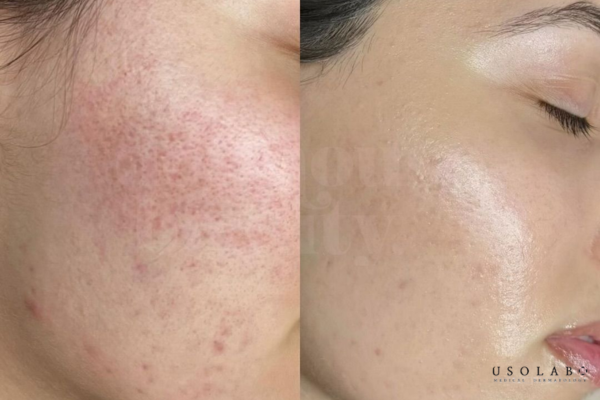 kem phục hồi da sau treatment
