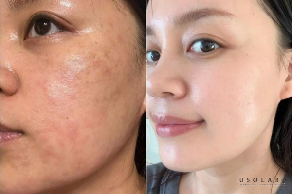 Chứa thành phần tan bầm và giảm sưng Chứa thành phần tan bầm và giảm sưng