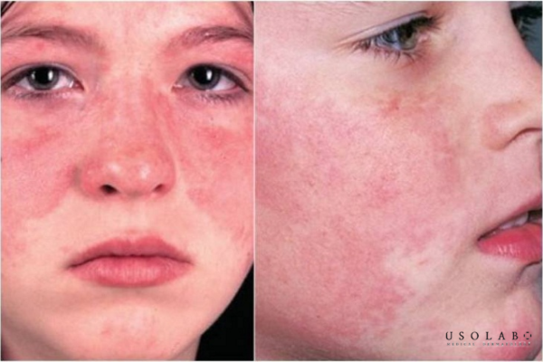 kem phục hồi sau peel