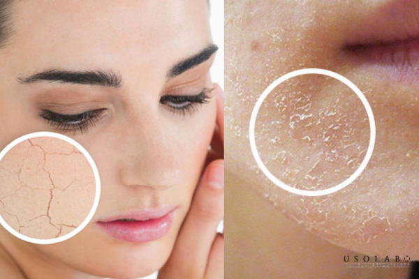 kem phục hồi sau peel