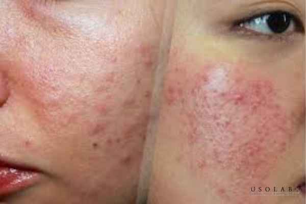 kem phục hồi sau peel