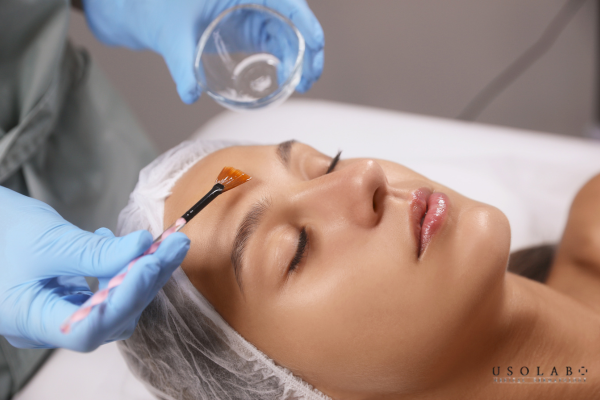 Ngay sau khi Chemical Peel