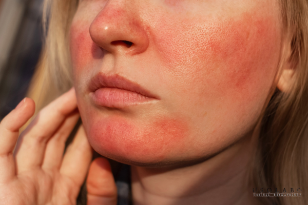 Da cháy nắng (Sunburn)