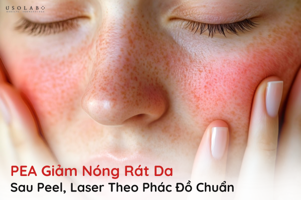 pea giảm nóng rát