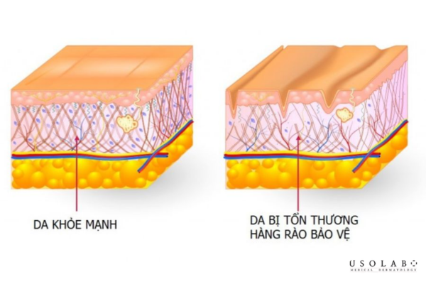 phục hồi hàng rào bảo vệ da