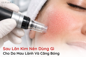 sau lăn kim nên dùng gì