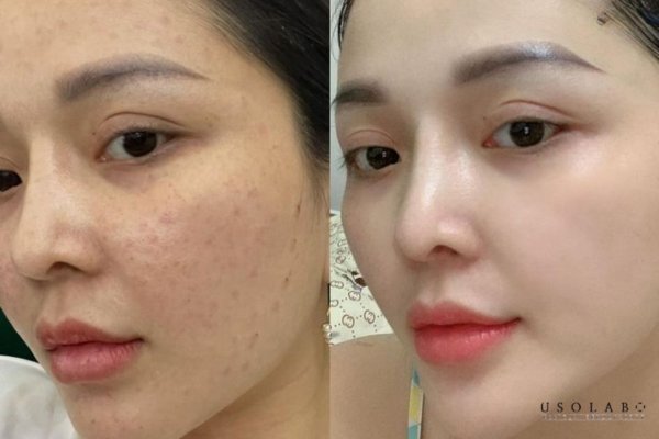 Vitamin K giảm bầm phát huy hiệu quả cao nhất trong những trường hợp cụ thể Vitamin K giảm bầm phát huy hiệu quả cao nhất trong những trường hợp cụ thể
