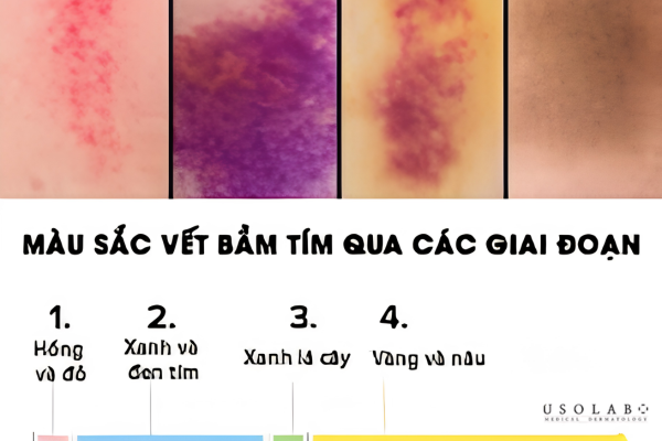 Phân biệt các màu sắc vết bầm và lộ trình mờ đi cùng Vitamin K Phân biệt các màu sắc vết bầm và lộ trình mờ đi cùng Vitamin K