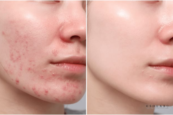 da bị châm chích sau treament