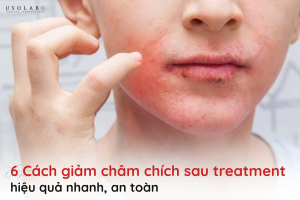 giảm châm chích sau treatment