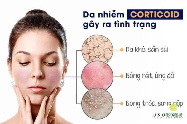 kem dưỡng trắng da không corticoid loại nào tốt