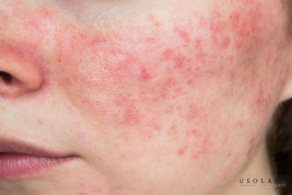kem dưỡng trắng da không corticoid loại nào tốt