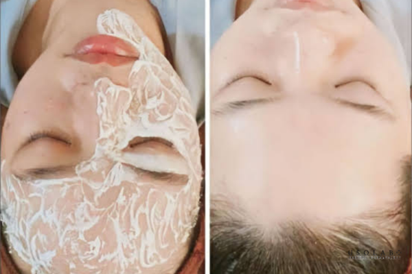 cấy trắng face và ủ trắng face cái nào tốt hơn