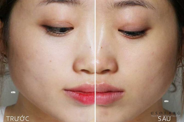 nên dùng dầu tẩy trang hay nước tẩy trang