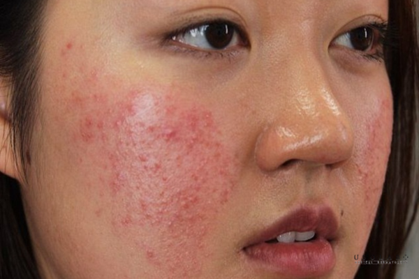phân biệt ủ trắng an toàn và kem trộn