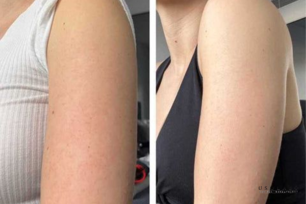 cách trị sạm da body tại nhà hiệu quả