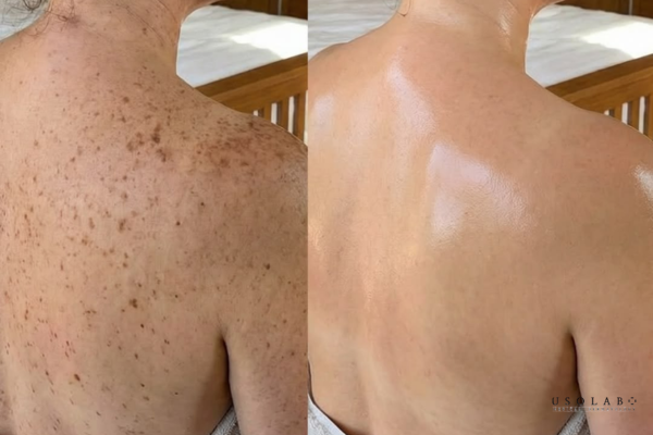 cách trị sạm da body tại nhà hiệu quả
