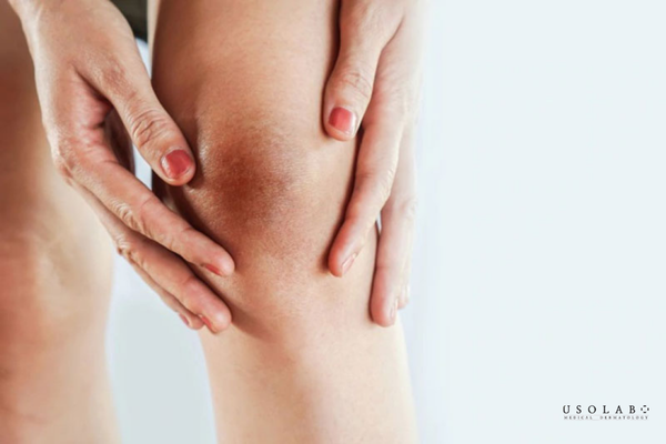 kem ủ kích trắng mờ thâm đầu gối khủy tay