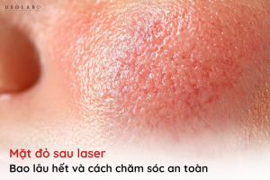 mặt đỏ sau laser