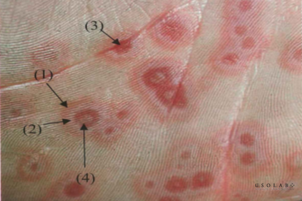 erythema là gì