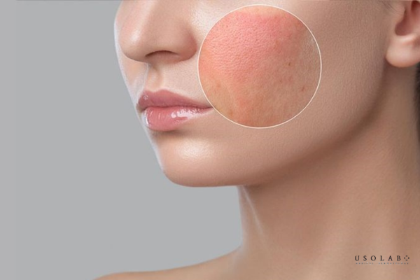 erythema là gì