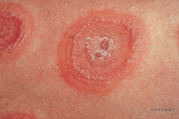 erythema là gì