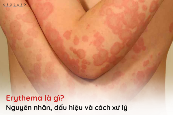 erythema là gì
