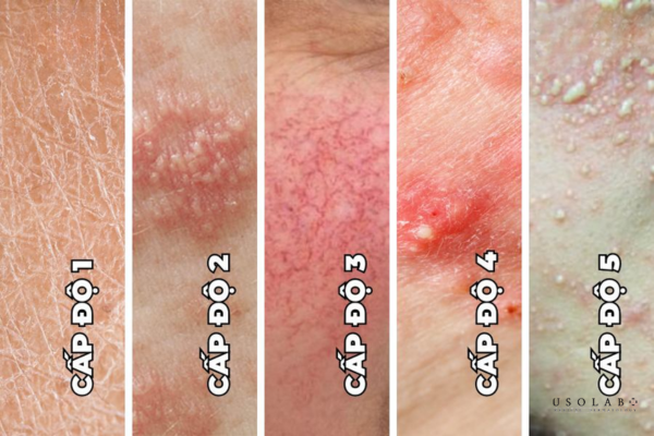 dấu hiệu nhận biết kem ủ trắng có chứa corticoid