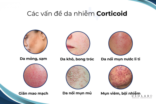 dấu hiệu nhận biết kem ủ trắng có chứa corticoid