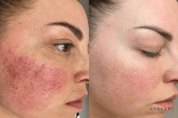 mặt đỏ sau laser