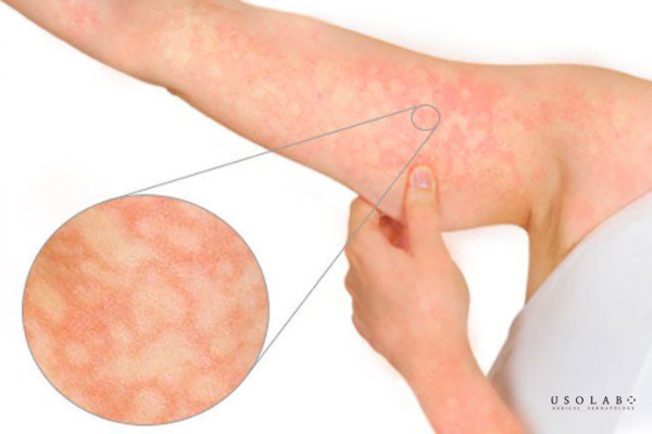 erythema là gì