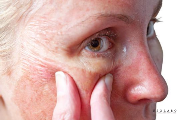 da bị khô căng sau peel