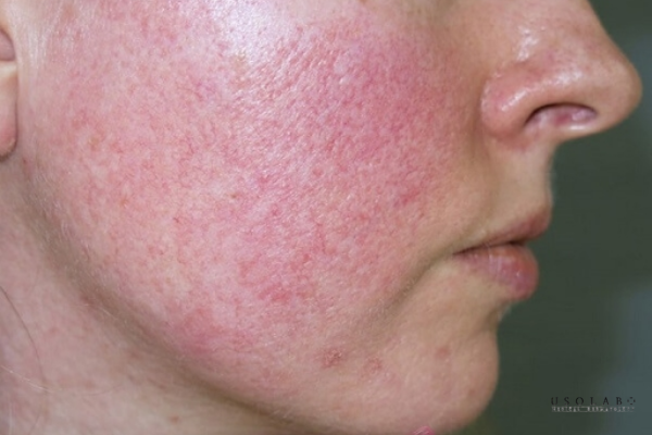 da bị kích ứng sau treatment